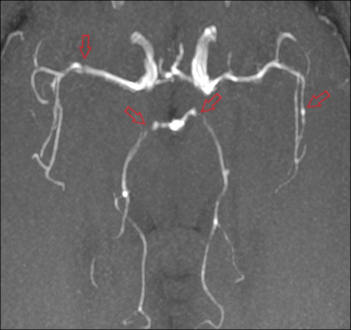 Slika 2a. CT-angiografija