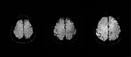 Slika 1. Susceptibilno poudarjeno slikanje (SWI) januarja 2016 na MR tomografu jakosti 1,5 T: v poteku primarne motorične skorje ni bilo videti patoloških sprememb. 