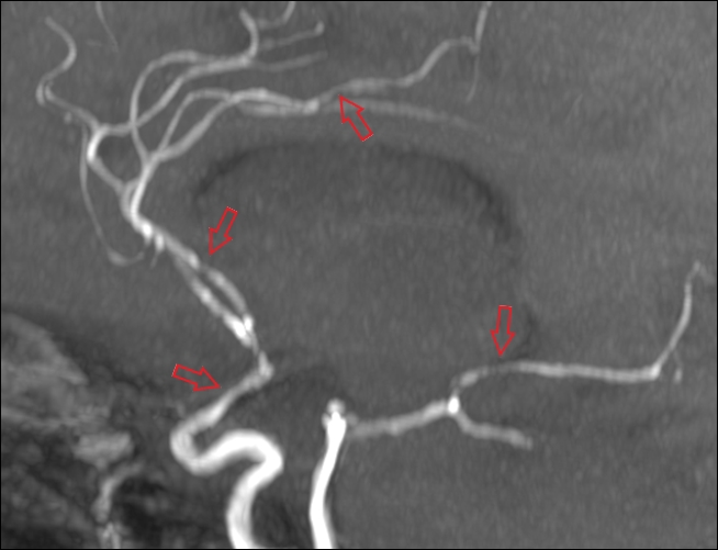 Slika 2. CT-angiografija